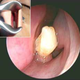 Illustration for article titled Doctors Removed a Tooth Growing Into a Man's Nose